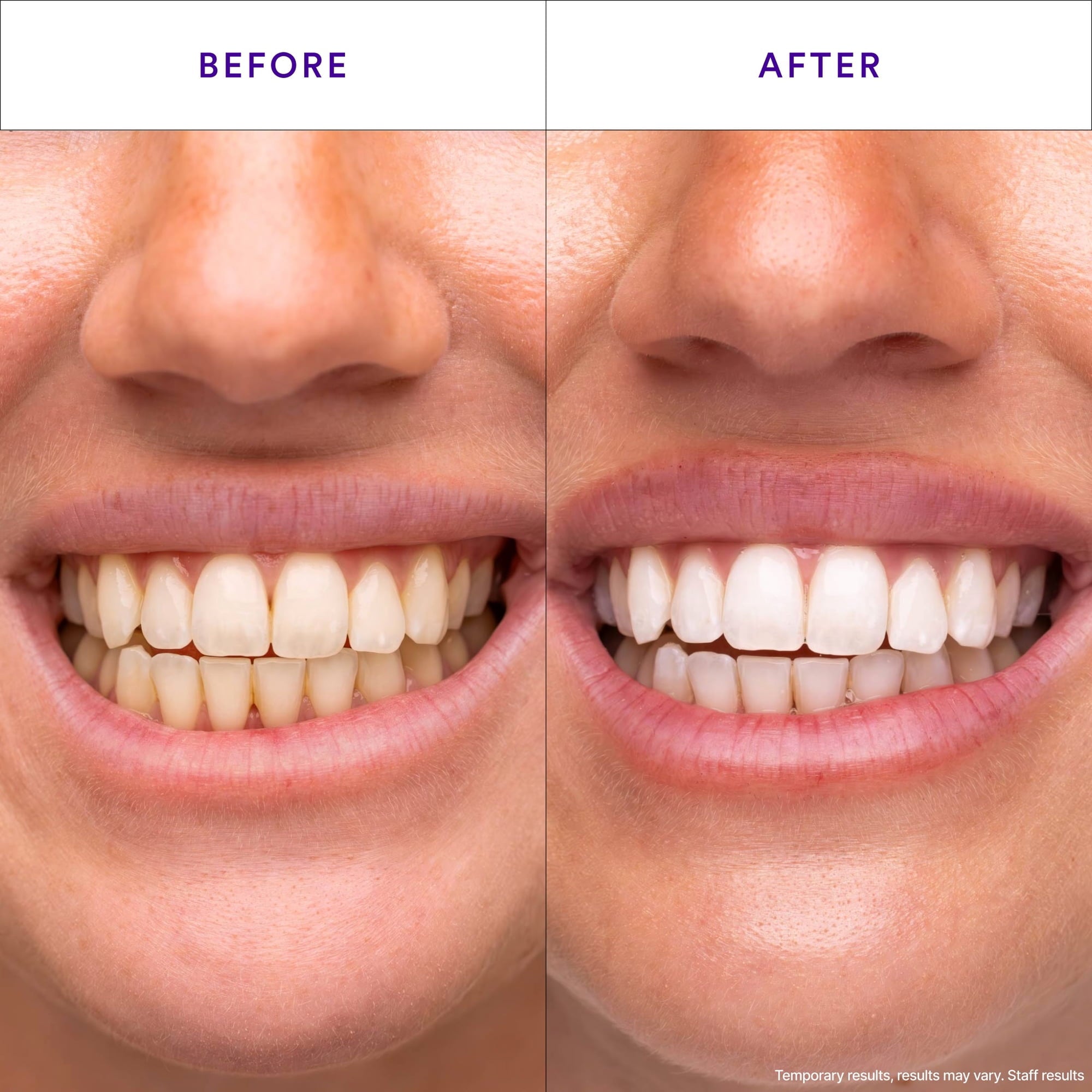 Purple Instant Whitening Strips – 14 par (28 szt.) | Wybielanie bez nadwrażliwości